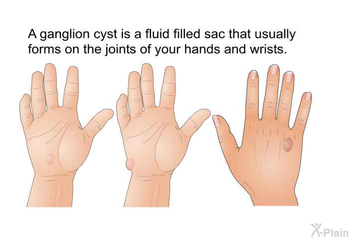 A ganglion cyst is a fluid filled sac that usually forms on the joints of your hands and wrists.