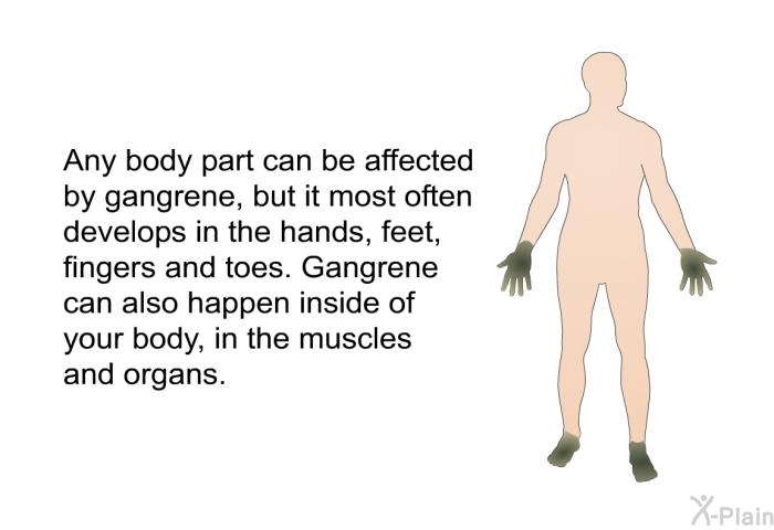 Any body part can be affected by gangrene, but it most often develops in the hands, feet, fingers and toes. Gangrene can also happen inside of your body, in the muscles and organs.