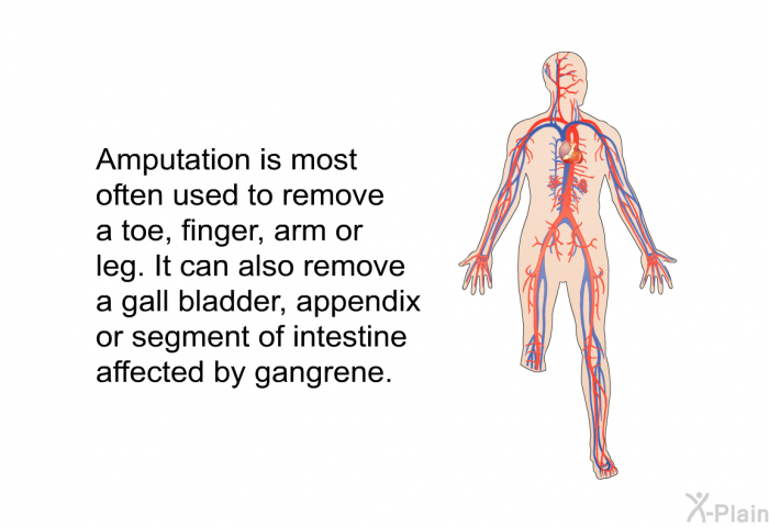 Amputation is most often used to remove a toe, finger, arm or leg. It can also remove a gall bladder, appendix or segment of intestine affected by gangrene.