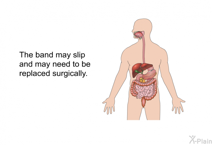 The band may slip and may need to be replaced surgically.