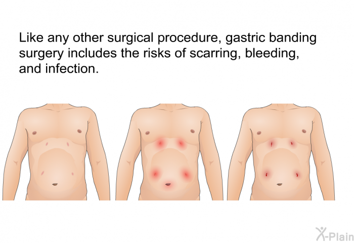 Like any other surgical procedure, gastric banding surgery includes the risks of scarring, bleeding, and infection.