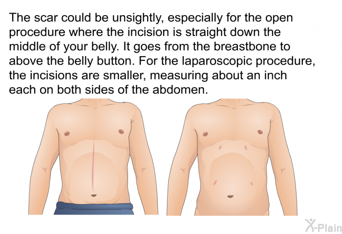 The scar could be unsightly, especially for the open procedure where the incision is straight down the middle of your belly. It goes from the breastbone to above the belly button. For the laparoscopic procedure, the incisions are smaller, measuring about an inch each on both sides of the abdomen.
