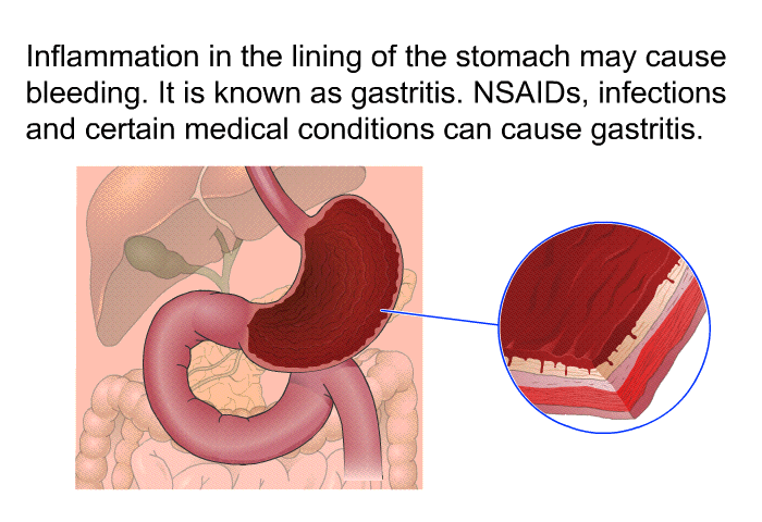 Inflammation in the lining of the stomach may cause bleeding. It is known as gastritis. NSAIDs, infections and certain medical conditions can cause gastritis.