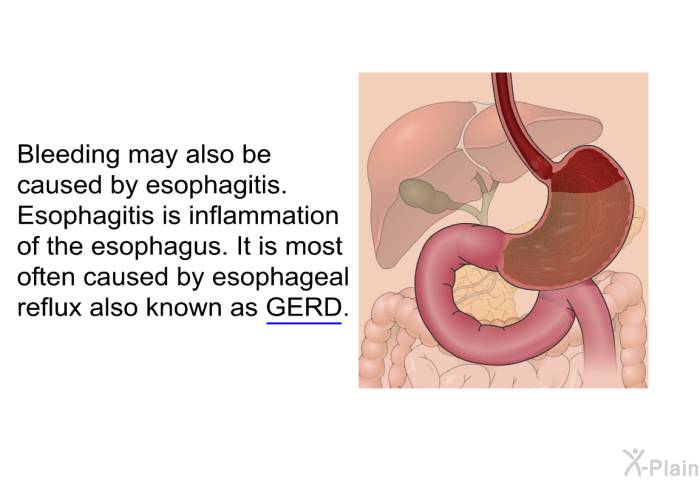 Bleeding may also be caused by esophagitis. Esophagitis is inflammation of the esophagus. It is most often caused by esophageal reflux also known as GERD.