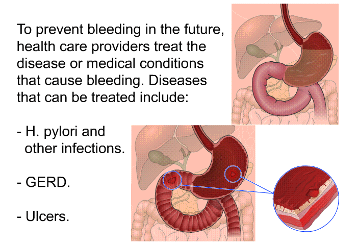 To prevent bleeding in the future, health care providers treat the disease or medical conditions that cause bleeding. Diseases that can be treated include:  H. pylori and other infections. GERD. Ulcers.