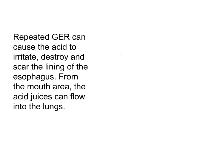 Repeated GER can cause the acid to irritate, destroy and scar the lining of the esophagus. From the mouth area, the acid juices can flow into the lungs.