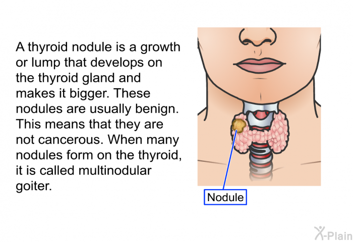 A thyroid nodule is a growth or lump that develops on the thyroid gland and makes it bigger. These nodules are usually benign. This means that they are not cancerous. When many nodules form on the thyroid, it is called multinodular goiter.