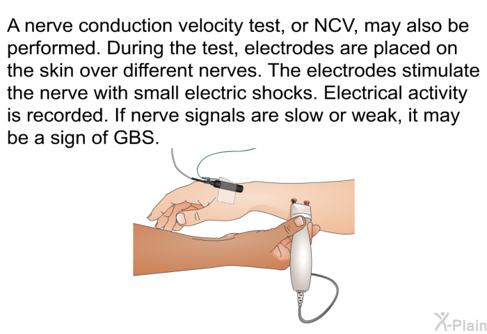 A nerve conduction velocity test, or NCV, may also be performed. During the test, electrodes are placed on the skin over different nerves. The electrodes stimulate the nerve with small electric shocks. Electrical activity is recorded. If nerve signals are slow or weak, it may be a sign of GBS.