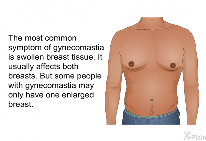 The most common symptom of gynecomastia is swollen breast tissue. It usually affects both breasts. But some people with gynecomastia may only have one enlarged breast.
