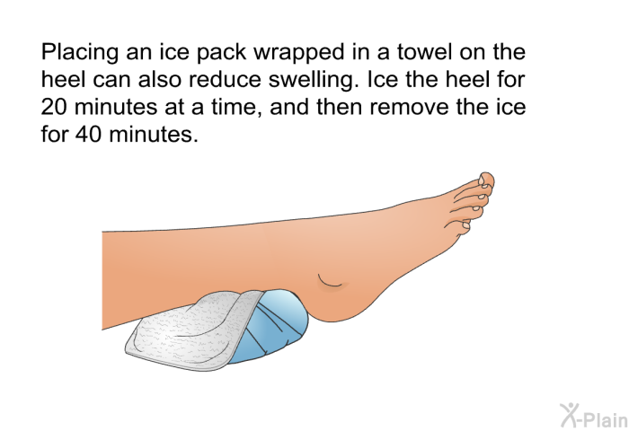 Placing an ice pack wrapped in a towel on the heel can also reduce swelling. Ice the heel for 20 minutes at a time, and then remove the ice for 40 minutes.