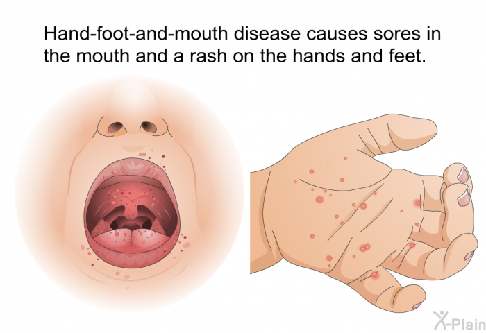 Hand-foot-and-mouth disease causes sores in the mouth and a rash on the hands and feet.