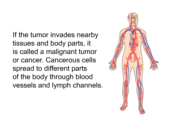 If the tumor invades nearby tissues and body parts, it is called a malignant tumor or cancer. Cancerous cells spread to different parts of the body through blood vessels and lymph channels.