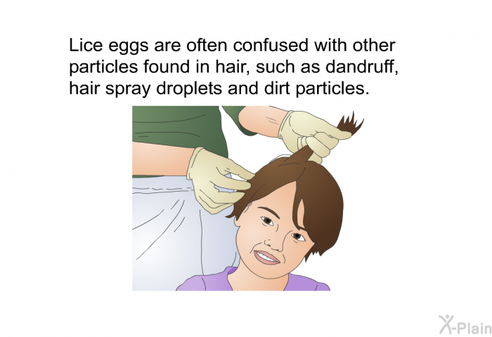 Lice eggs are often confused with other particles found in hair, such as dandruff, hair spray droplets and dirt particles.