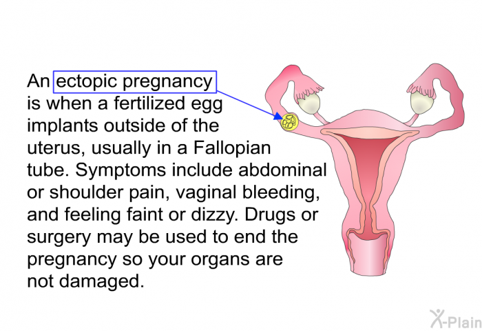 An ectopic pregnancy is when a fertilized egg implants outside of the uterus, usually in a Fallopian tube. Symptoms include abdominal or shoulder pain, vaginal bleeding, and feeling faint or dizzy. Drugs or surgery may be used to end the pregnancy so your organs are not damaged.