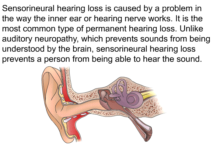 Sensorineural hearing loss is caused by a problem in the way the inner ear or hearing nerve works. It is the most common type of permanent hearing loss. Unlike auditory neuropathy, which prevents sounds from being understood by the brain, sensorineural hearing loss prevents a person from being able to hear the sound.