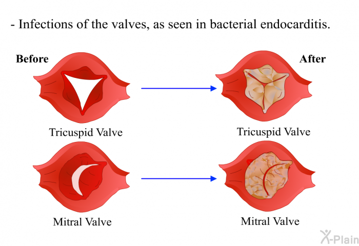 Infections of the valves, as seen in bacterial endocarditis.