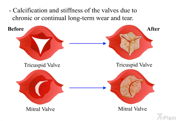 Calcification and stiffness of the valves due to chronic or continual long-term wear and tear.