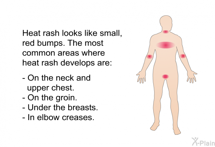  Heat Illnesses