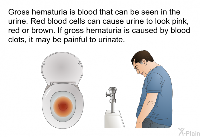 Gross hematuria is blood that can be seen in the urine. Red blood cells can cause urine to look pink, red or brown. If gross hematuria is caused by blood clots, it may be painful to urinate.