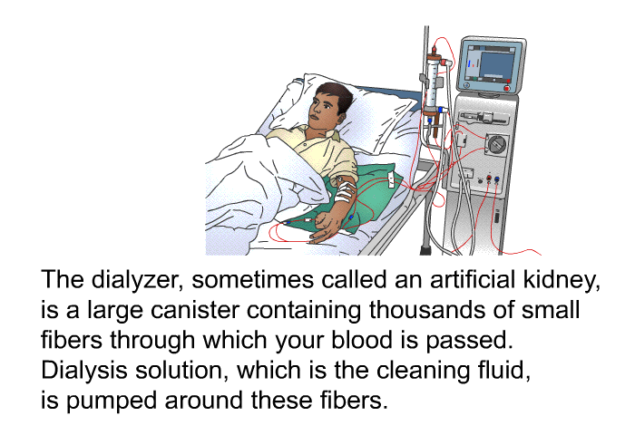 The dialyzer, sometimes called an artificial kidney, is a large canister containing thousands of small fibers through which your blood is passed. Dialysis solution, which is the cleaning fluid, is pumped around these fibers.