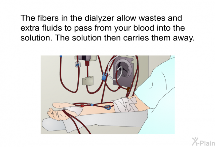 The fibers in the dialyzer allow wastes and extra fluids to pass from your blood into the solution. The solution then carries them away.