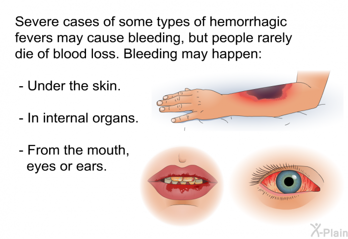Severe cases of some types of hemorrhagic fevers may cause bleeding, but people rarely die of blood loss. Bleeding may happen:  Under the skin. In internal organs. From the mouth, eyes or ears.
