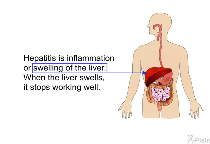 Hepatitis is inflammation or swelling of the liver. When the liver swells, it stops working well.