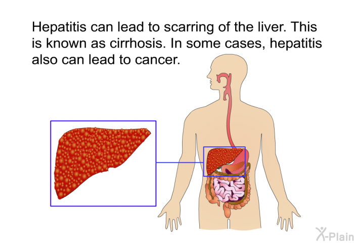 Hepatitis can lead to scarring of the liver. This is known as cirrhosis. In some cases, hepatitis also can lead to cancer.