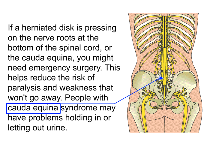 If a herniated disk is pressing on the nerve roots at the bottom of the spinal cord, or the cauda equina, you might need emergency surgery. This helps reduce the risk of paralysis and weakness that won't go away. People with cauda equina syndrome may have problems holding in or letting out urine.
