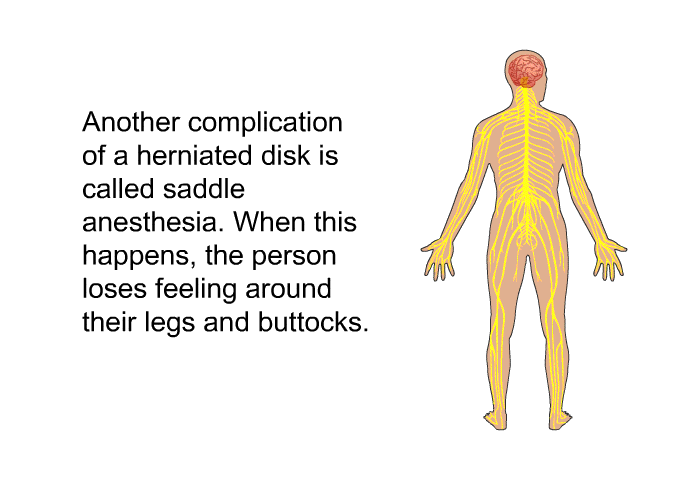 Another complication of a herniated disk is called saddle anesthesia. When this happens, the person loses feeling around their legs and buttocks.