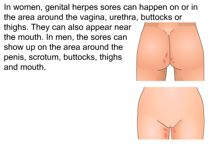 In women, genital herpes sores can happen on or in the area around the vagina, urethra, buttocks or thighs. They can also appear near the mouth. In men, the sores can show up on the area around the penis, scrotum, buttocks, thighs and mouth.