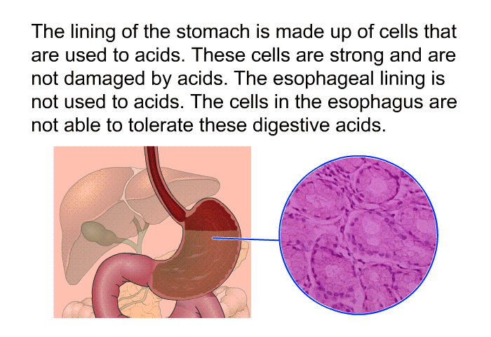 The lining of the stomach is made up of cells that are used to acids. These cells are strong and are not damaged by acids. The esophageal lining is not used to acids. The cells in the esophagus are not able to tolerate these digestive acids.