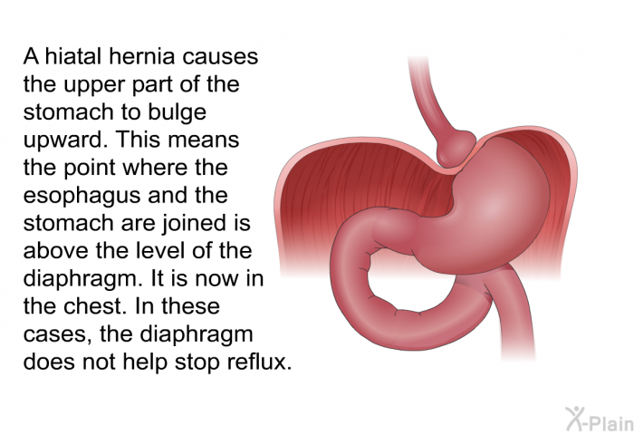 A hiatal hernia causes the upper part of the stomach to bulge upward. This means the point where the esophagus and the stomach are joined is above the level of the diaphragm. It is now in the chest. In these cases, the diaphragm does not help stop reflux.