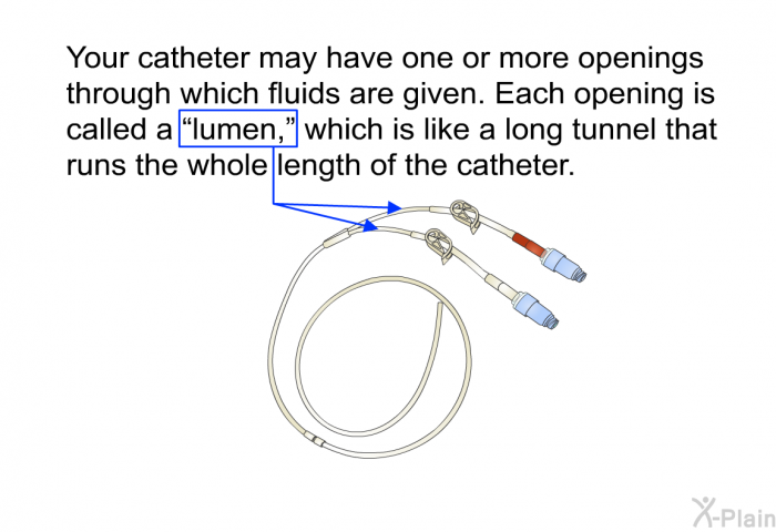 Your catheter may have one or more openings through which fluids are given. Each opening is called a “lumen,” which is like a long tunnel that runs the whole length of the catheter.