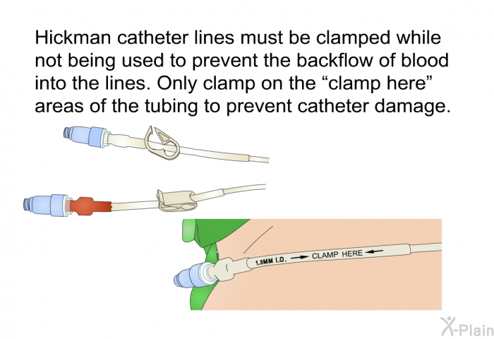 Hickman catheter lines must be clamped while not being used to prevent the backflow of blood into the lines. Only clamp on the &ldquo;clamp here&rdquo; areas of the tubing to prevent catheter damage.
