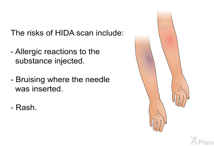 The risks of HIDA scan include:  Allergic reactions to the substance injected. Bruising where the needle was inserted.  Rash.