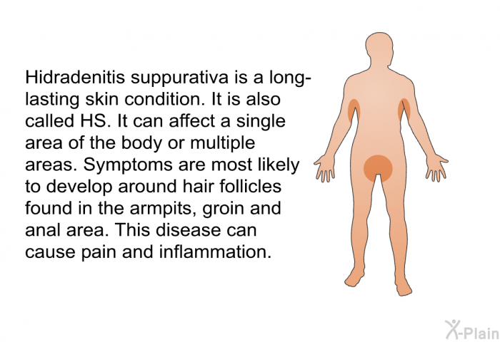 Hidradenitis suppurativa is a long-lasting skin condition. It is also called HS. It can affect a single area of the body or multiple areas. Symptoms are most likely to develop around hair follicles found in the armpits, groin and anal area. This disease can cause pain and inflammation.