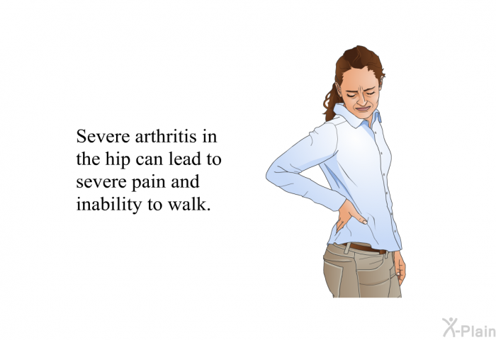 Severe arthritis in the hip can lead to severe pain and inability to walk.