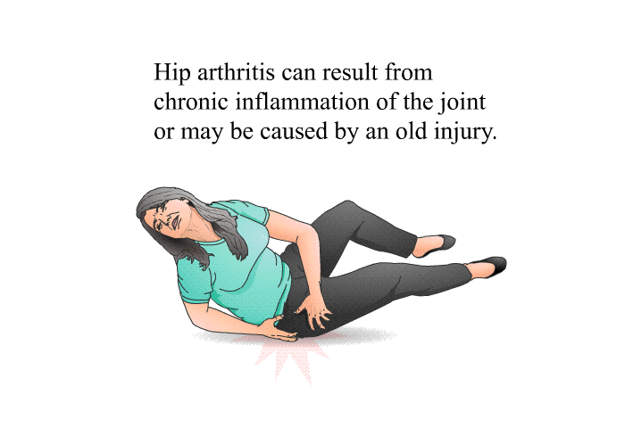 Hip arthritis can result from chronic inflammation of the joint or may be caused by an old injury.