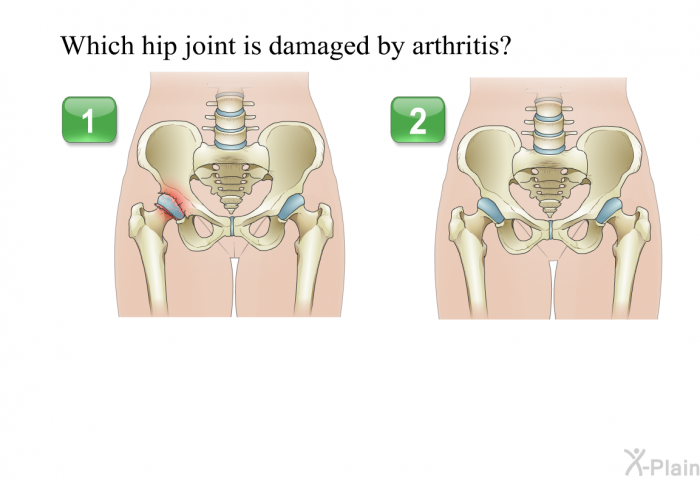 Which hip joint is damaged by arthritis?