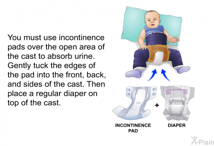 You must use incontinence pads over the open area of the cast to absorb urine. Gently tuck the edges of the pad into the front, back, and sides of the cast. Then place a regular diaper on top of the cast.