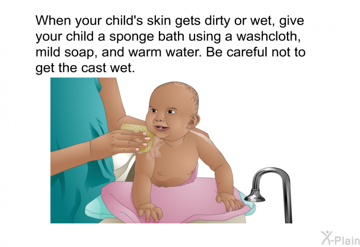 When your child's skin gets dirty or wet, give your child a sponge bath using a washcloth, mild soap, and warm water. Be careful not to get the cast wet.