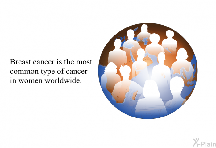 Breast cancer is the most common type of cancer in women worldwide.