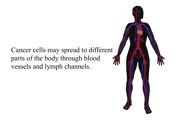 Cancer cells may spread to different parts of the body through blood vessels and lymph channels.