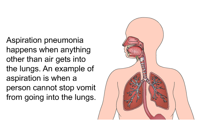 Aspiration pneumonia happens when anything other than air gets into the lungs. An example of aspiration is when a person cannot stop vomit from going into the lungs.