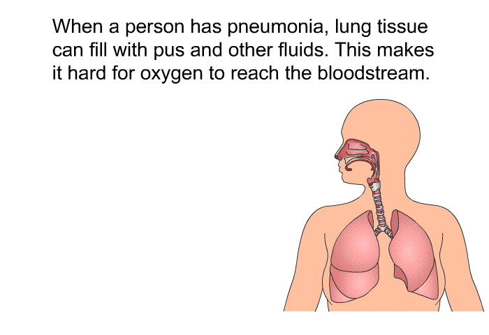 When a person has pneumonia, lung tissue can fill with pus and other fluids. This makes it hard for oxygen to reach the bloodstream.