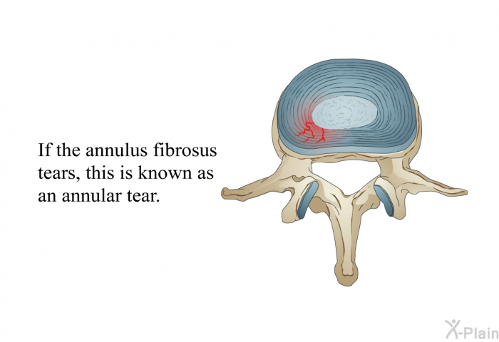 If the annulus fibrosus tears, this is known as an annular tear.