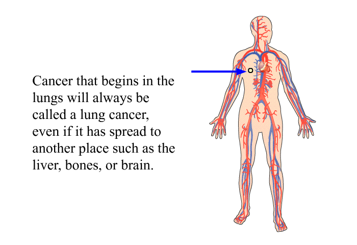 Cancer that begins in the lungs will always be called a lung cancer, even if it has spread to another place such as the liver, bones, or brain.