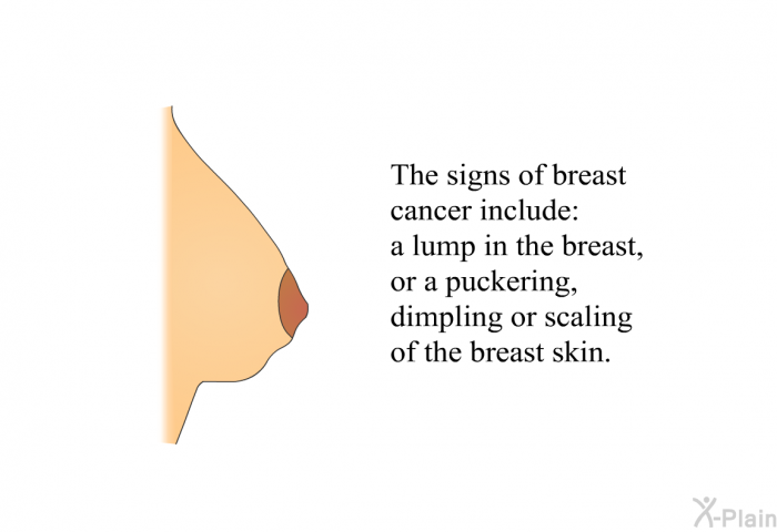 The signs of breast cancer include a lump in the breast, or a puckering, dimpling or scaling of the breast skin.