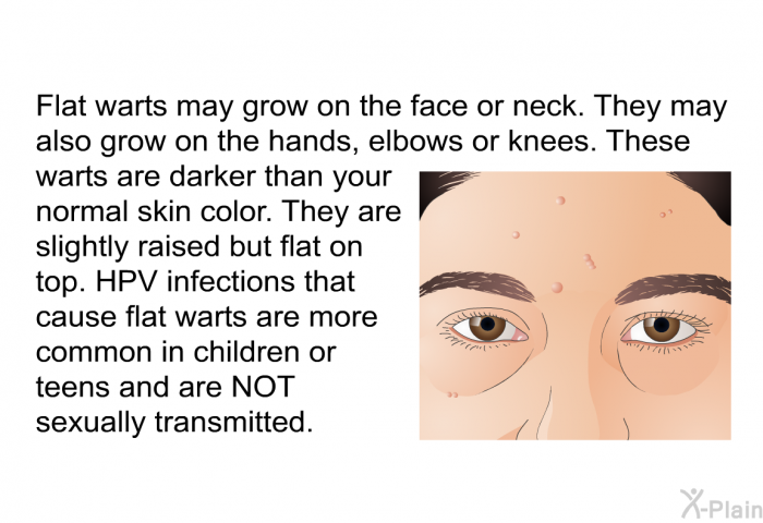 Flat warts may grow on the face or neck. They may also grow on the hands, elbows or knees. These warts are darker than your normal skin color. They are slightly raised but flat on top. HPV infections that cause flat warts are more common in children or teens and are NOT sexually transmitted.